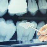 Bringing dental x-ray technology into the fast lane