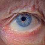Flinders researchers find new marker for glaucoma