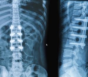 Flinders University's MDPP will design and prototype an instrument to enable bone graft delivery during minimally invasive spinal fusion procedures. Picture: Shutterstock