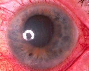 Glaucoma eye