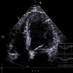 Sudden cardiac deaths key focus of new imaging technology