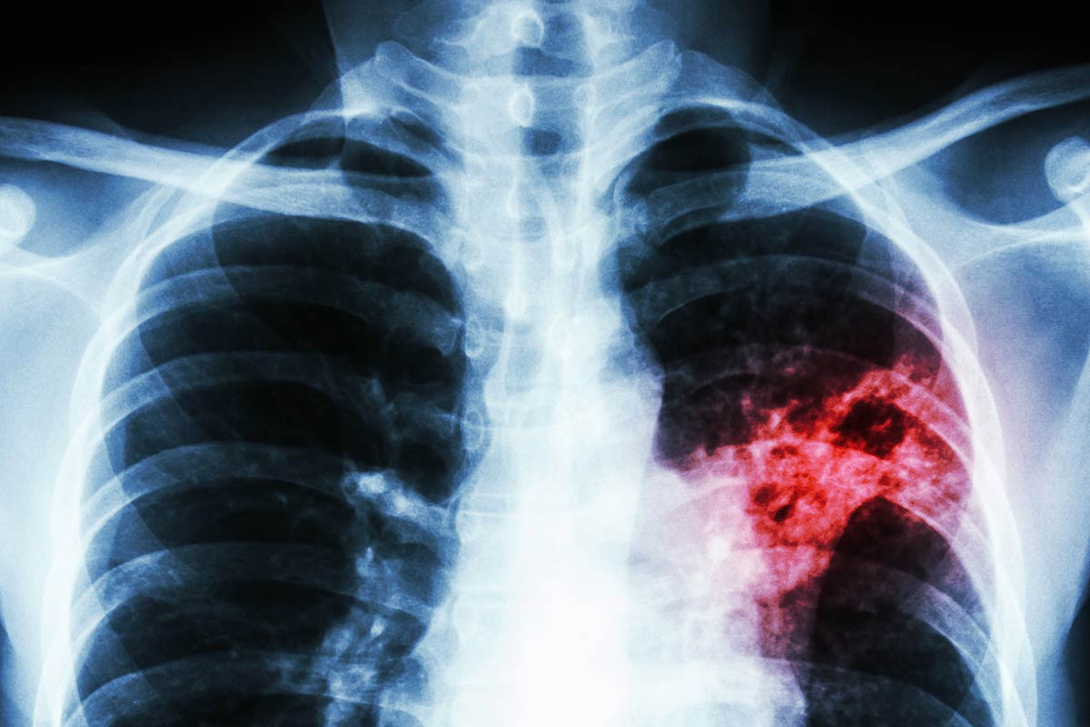 Stock photo of a chest x-ray showing tuberculosis infection (colourised) . Photo: iStock.