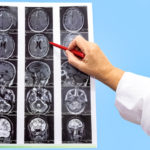 Poor brain cancer survival outcomes on the rise