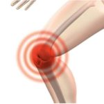 Nerve block for knee pain relief